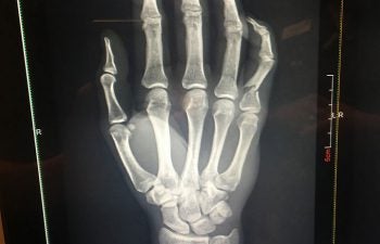 Cole-Seely-hand-injury-06-30-2016