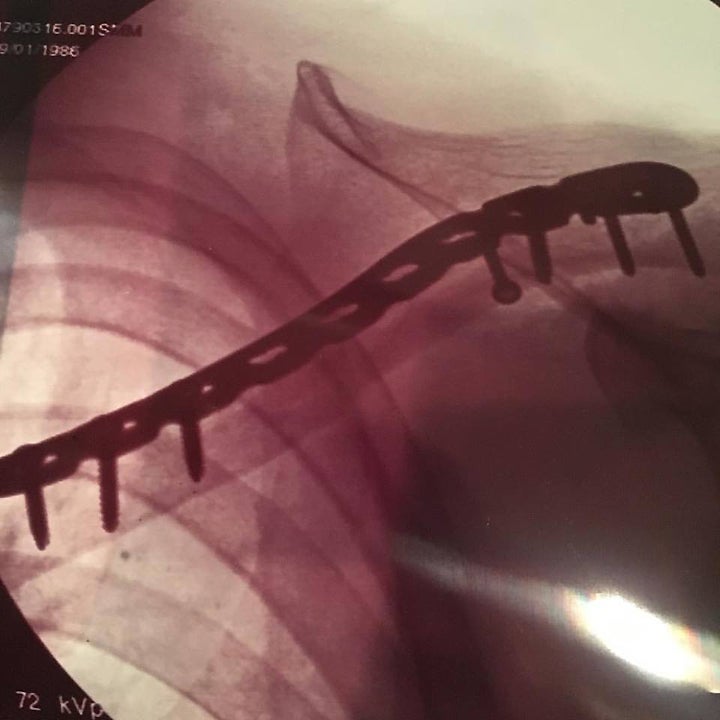 Reigning Baja 1000 Champion Colton Udall posted this video of his broken clavicle on his Instagram page. The injury, suffered Tuesday night, will keep him from competing with the Ox Motorsports 1X Honda team in the 2016 SCORE Baja 1000, which starts tomorrow. COLTON UDALL INSTAGRAM PHOTO.